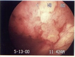  view of a papillary bladder tumor (top); the bladder wall is visible on the bottom right